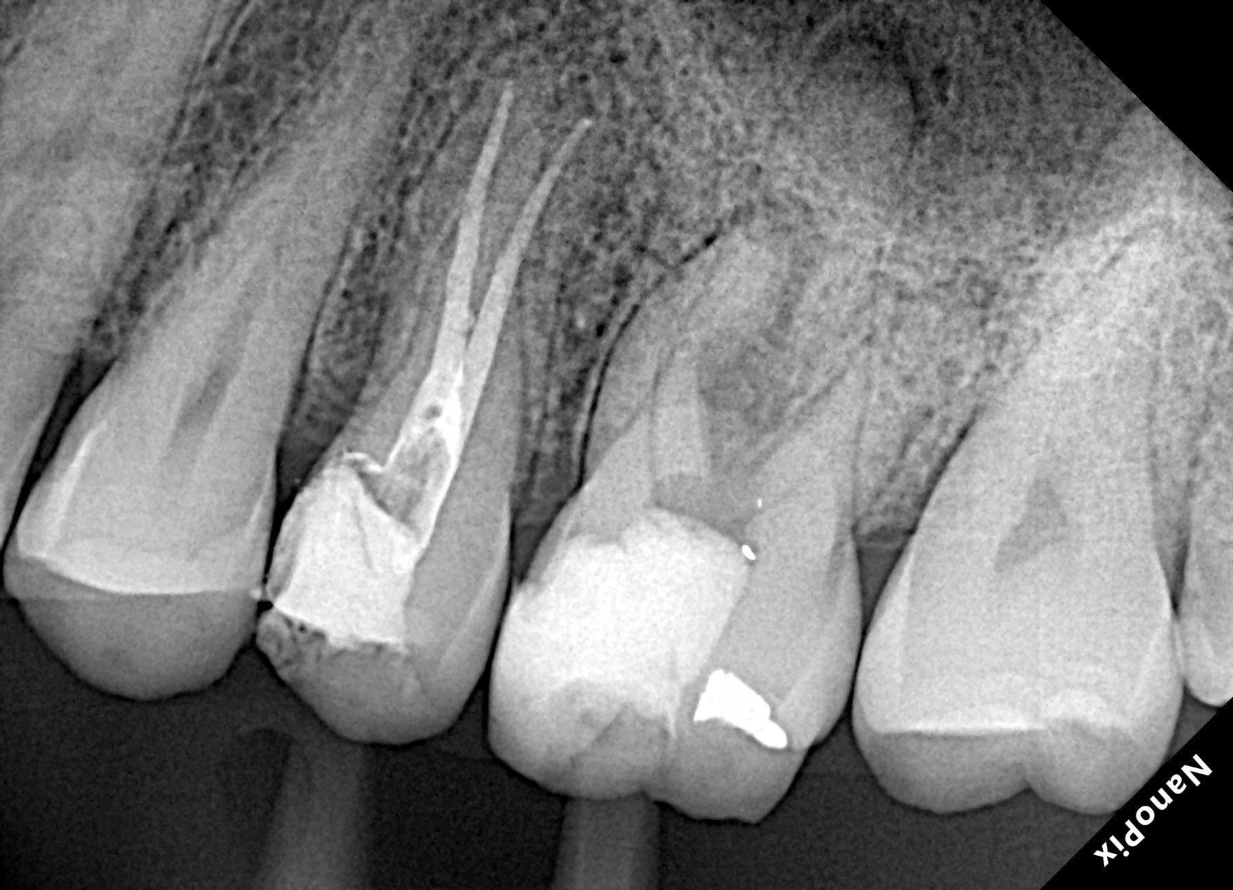 Radiografia antes do tratamento
