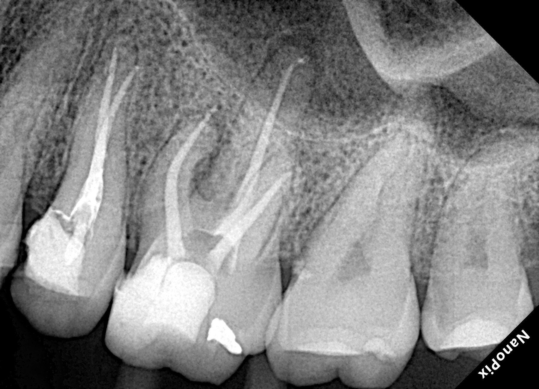 Radiografia após o tratamento