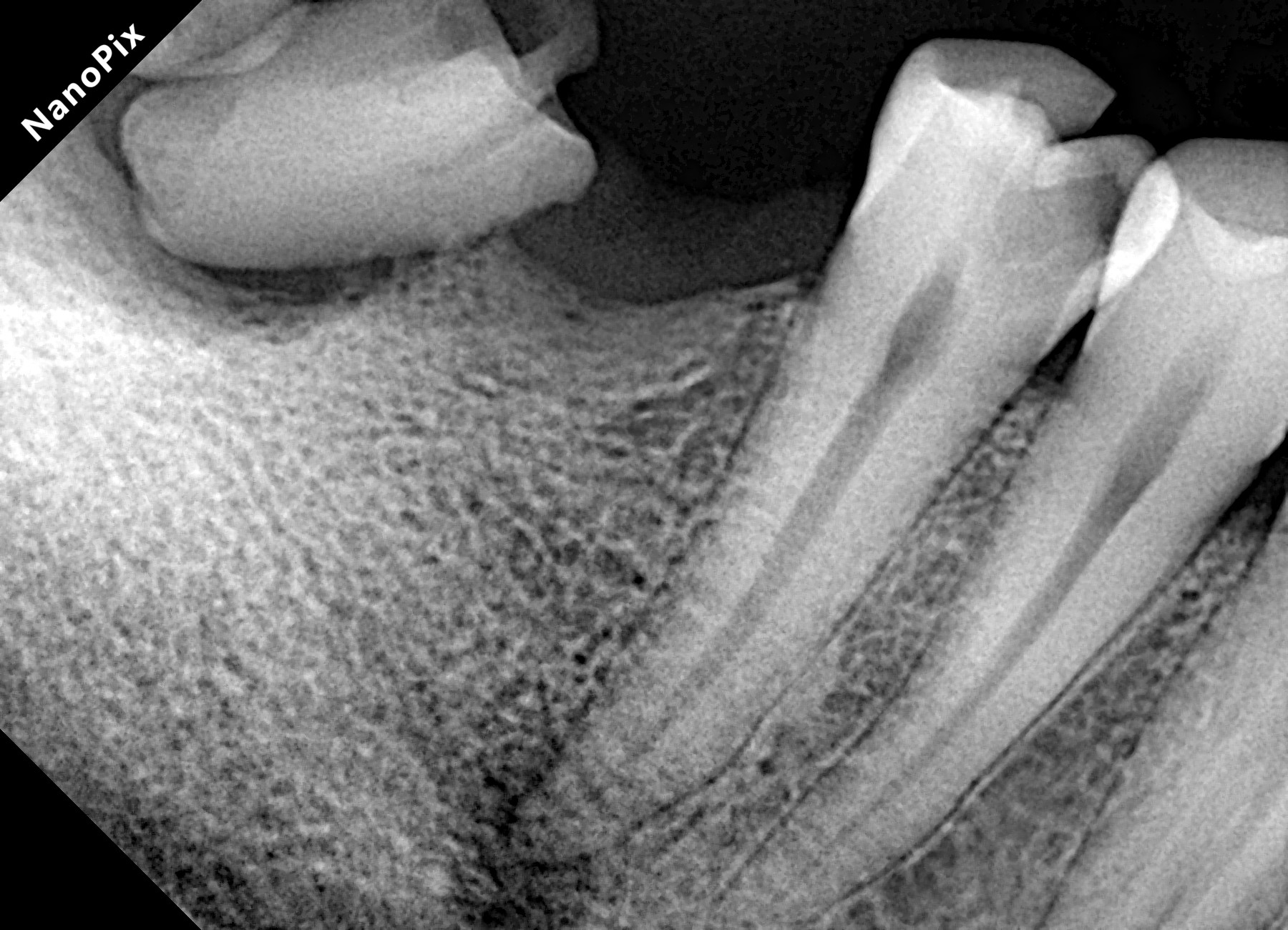 Radiografia antes do tratamento