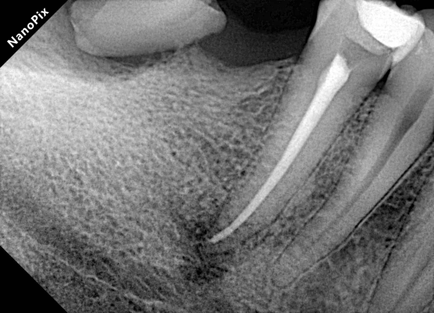 Radiografia após o tratamento