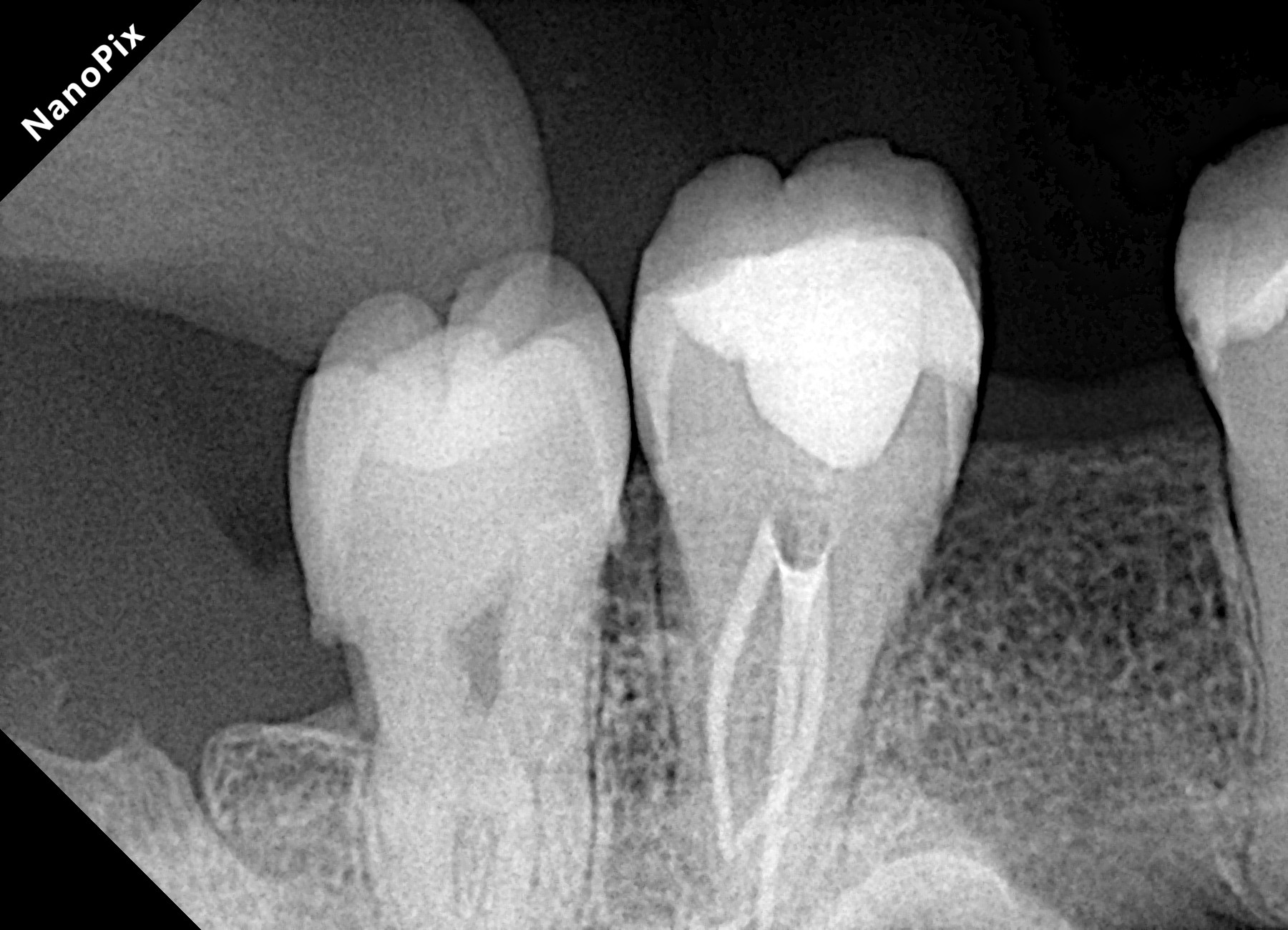 Radiografia após o tratamento