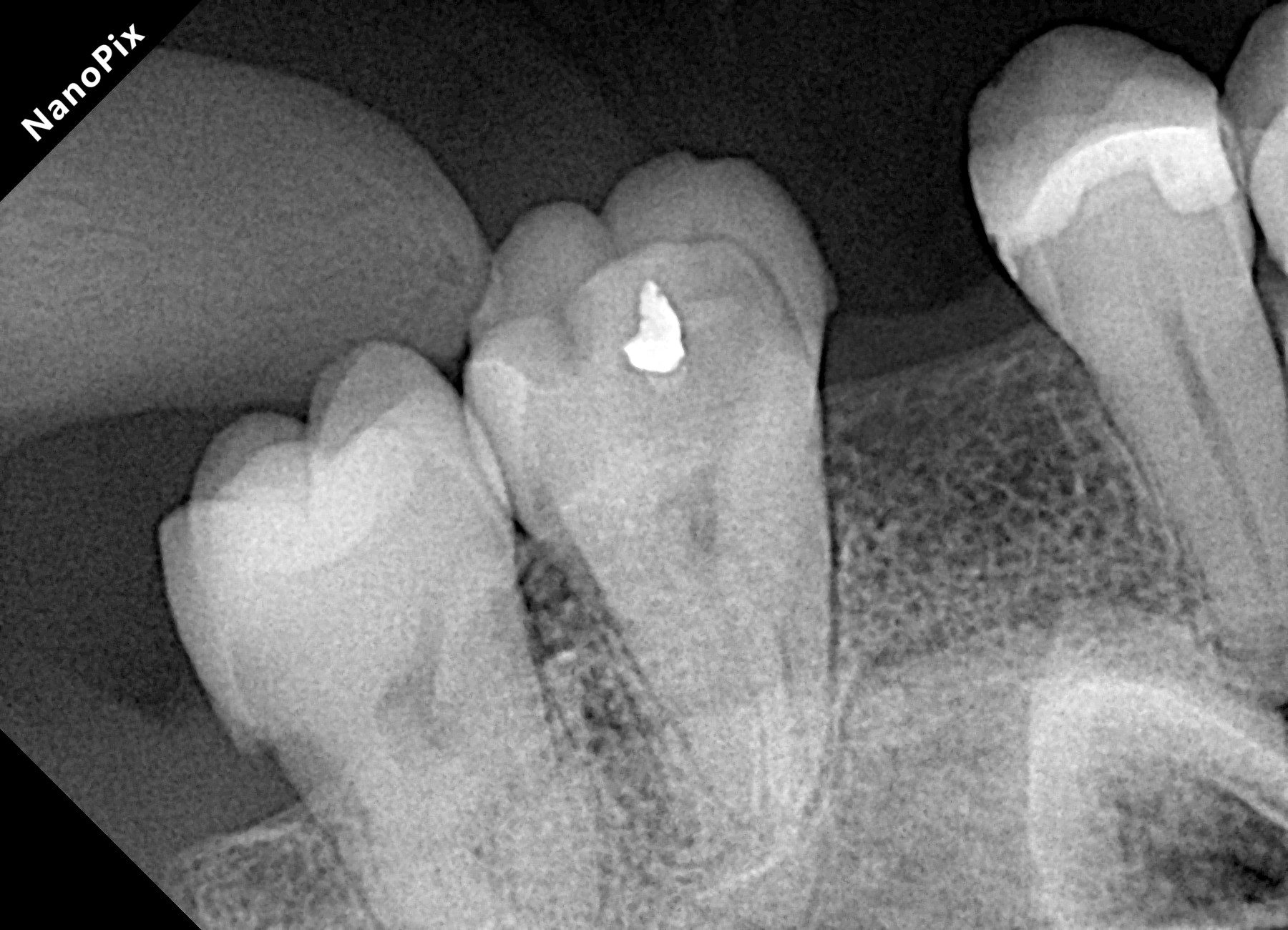 Radiografia antes do tratamento