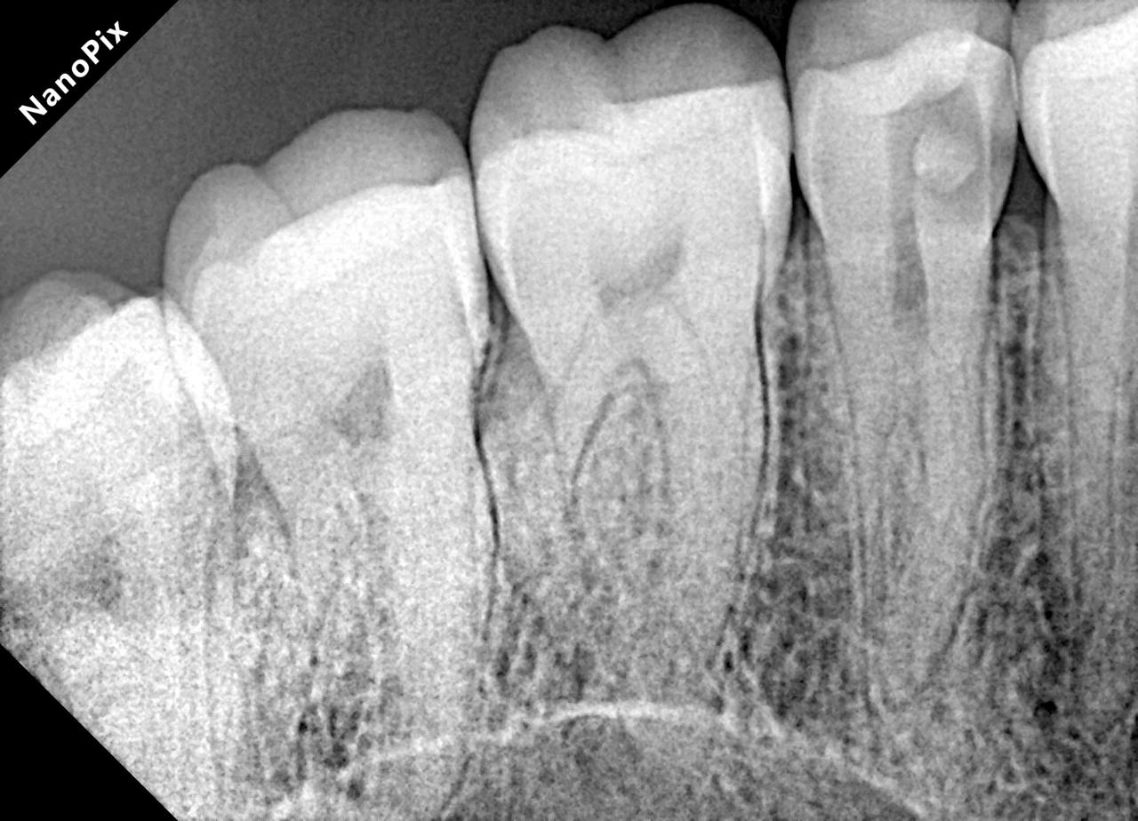 Radiografia antes do tratamento