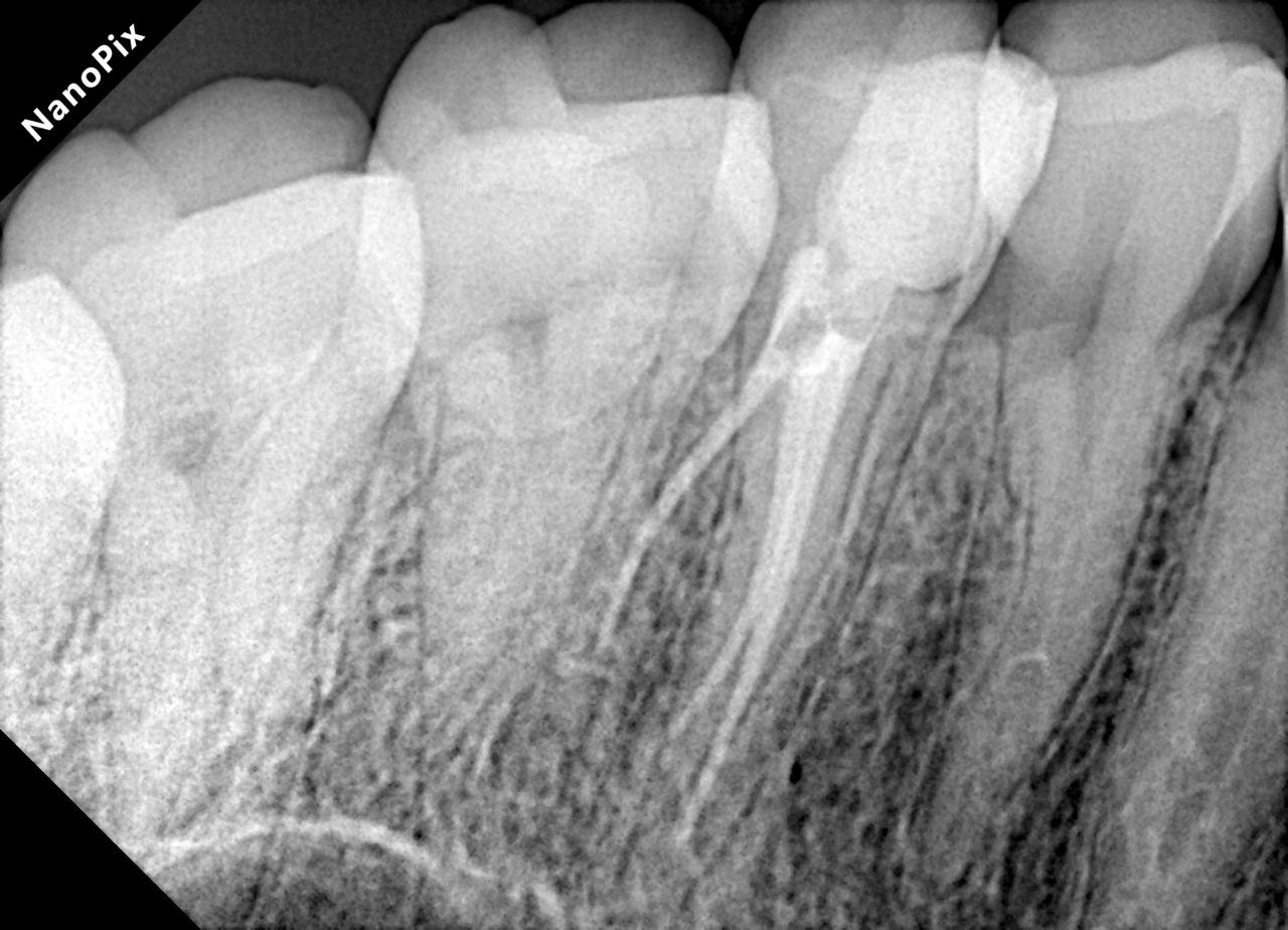 Radiografia após o tratamento