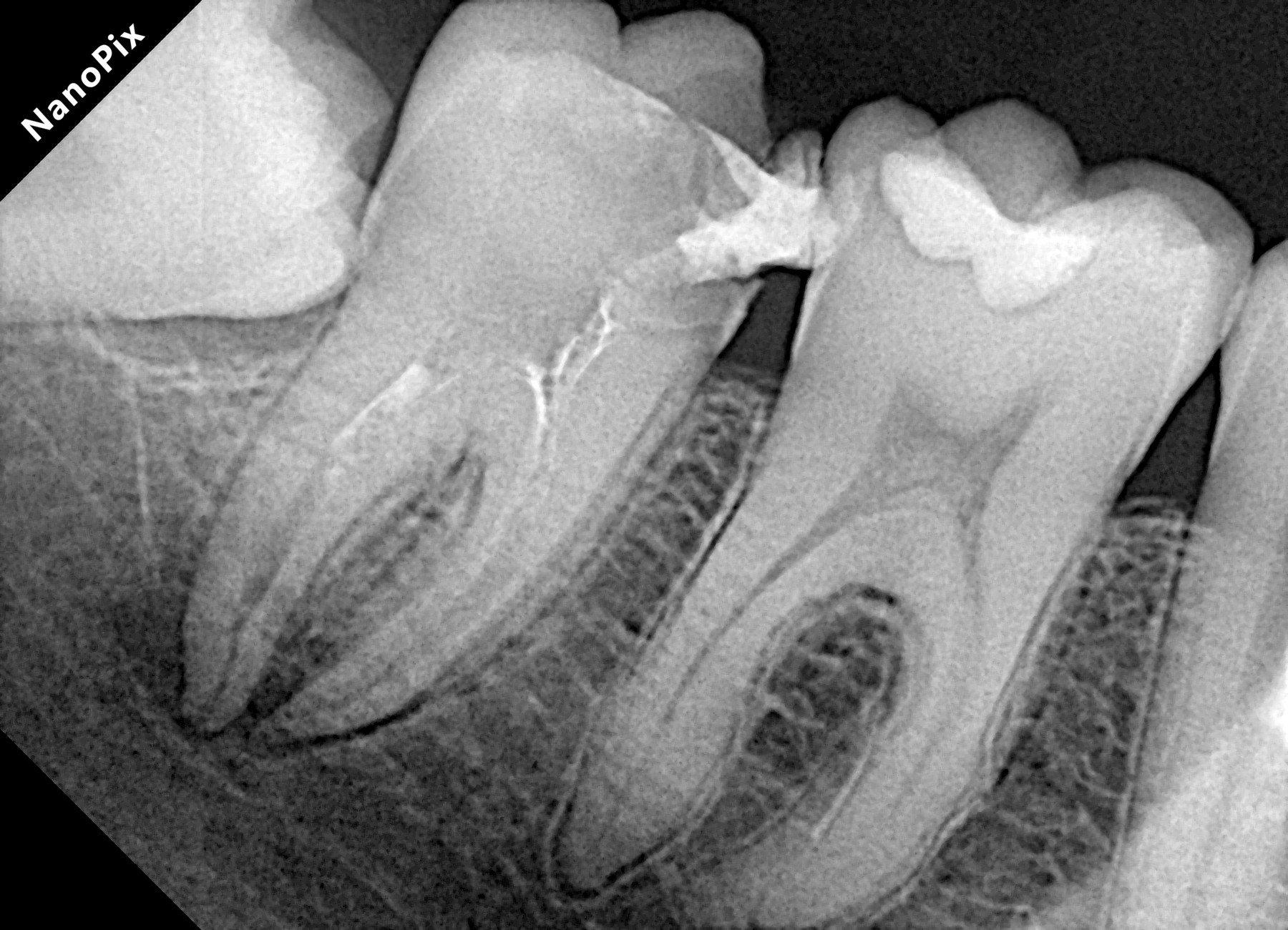 Radiografia antes do tratamento