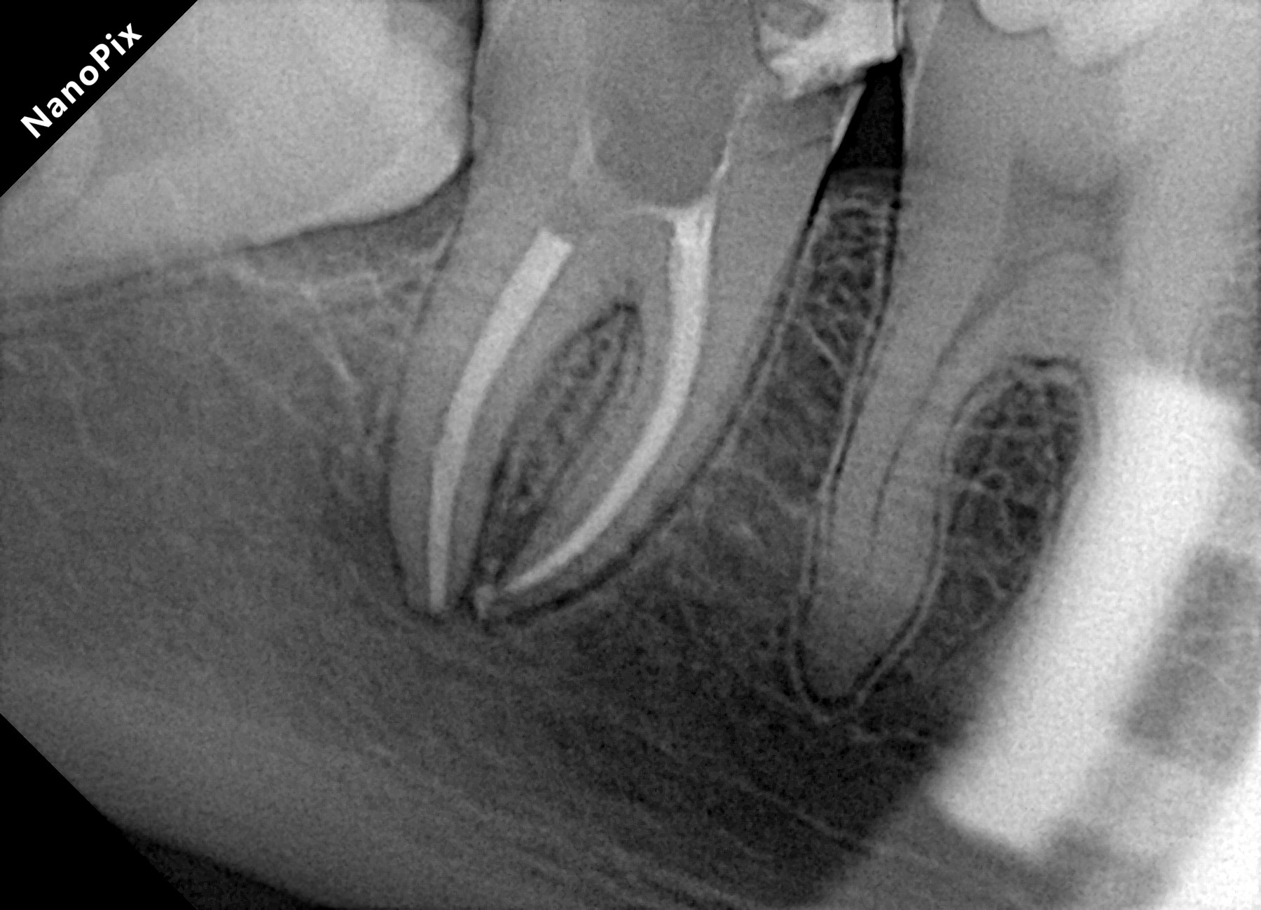 Radiografia após o tratamento