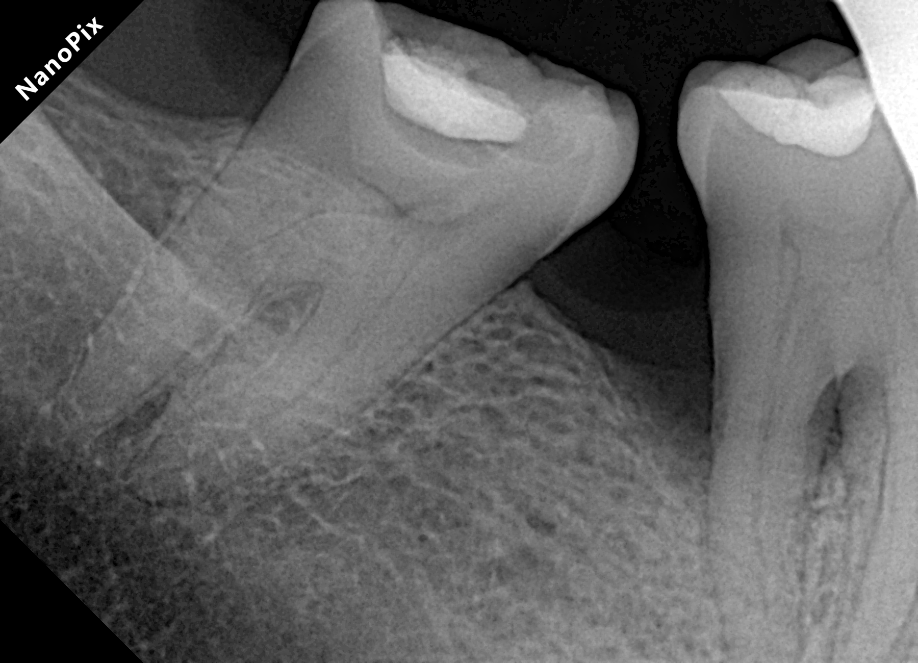 Radiografia antes do tratamento