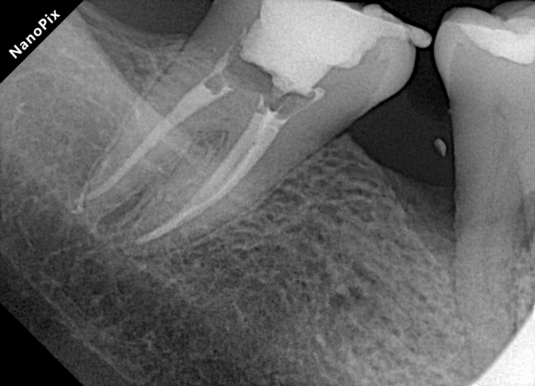 Radiografia após o tratamento