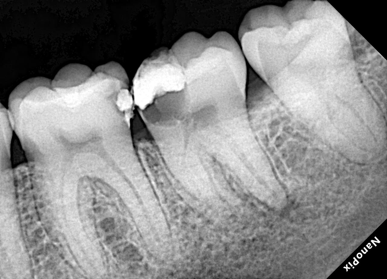 Radiografia antes do tratamento