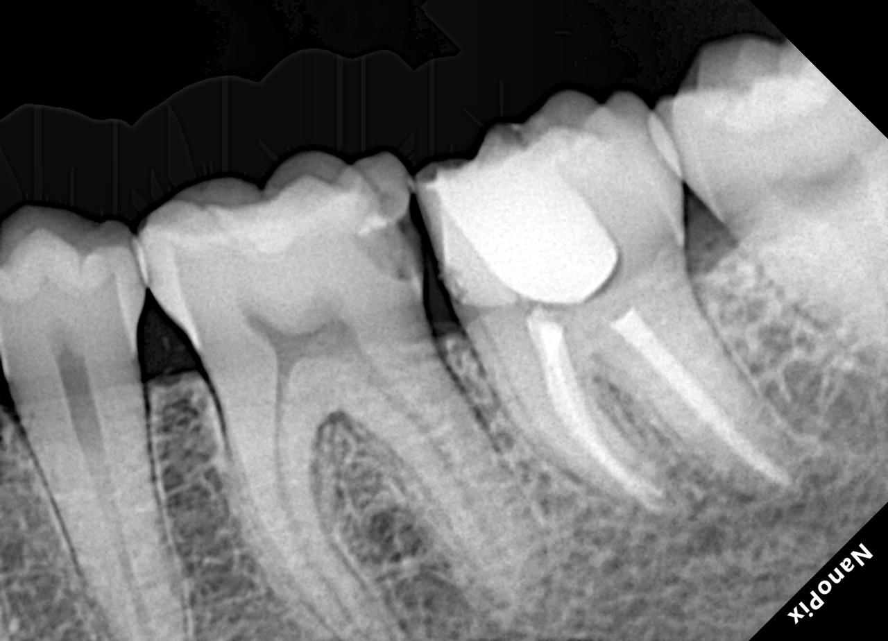 Radiografia após o tratamento