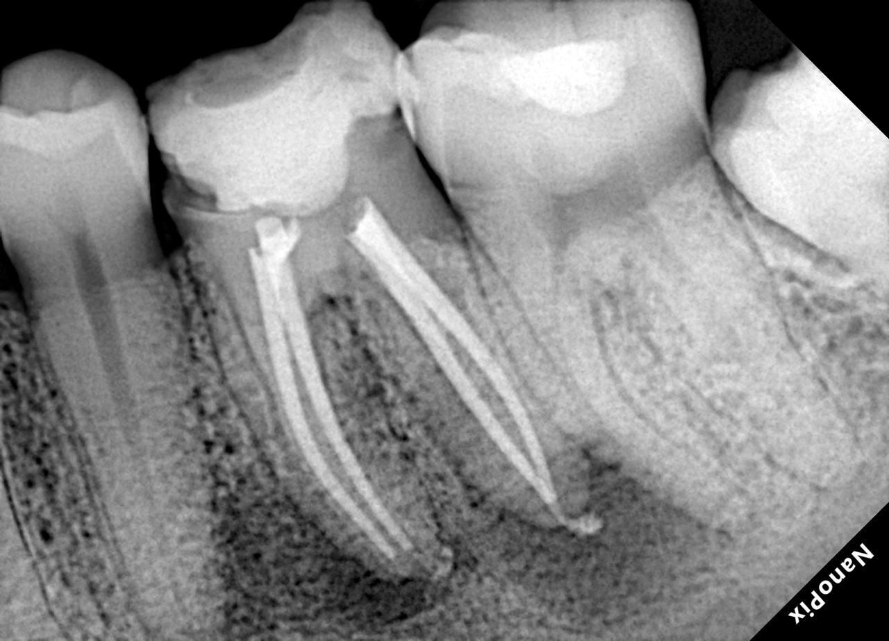 Radiografia após o tratamento