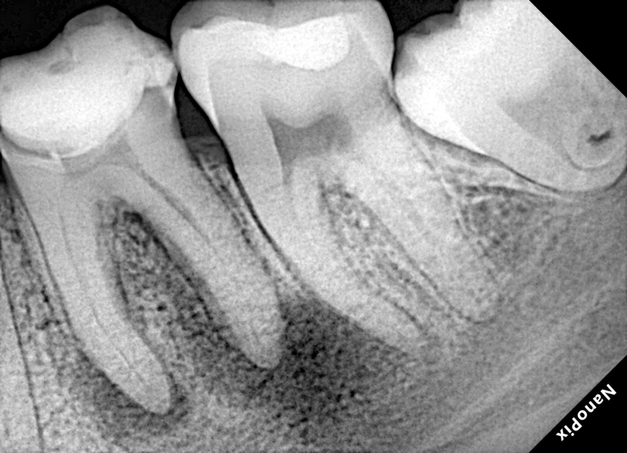Radiografia antes do tratamento