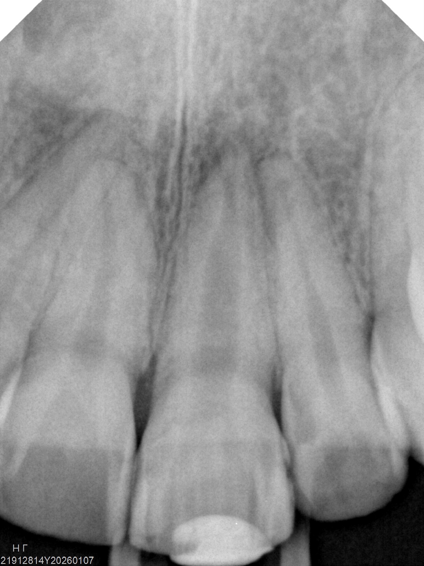 Radiografia antes do tratamento
