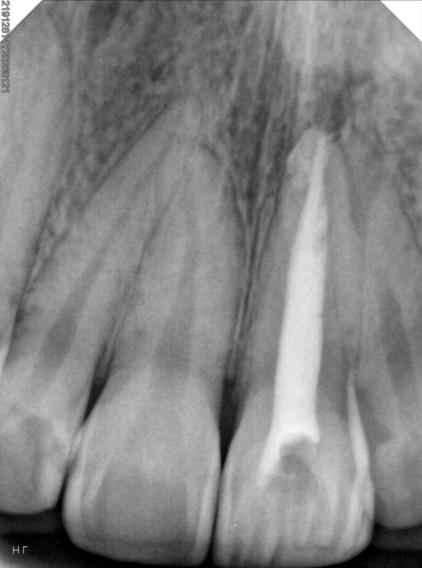 Radiografia após o tratamento